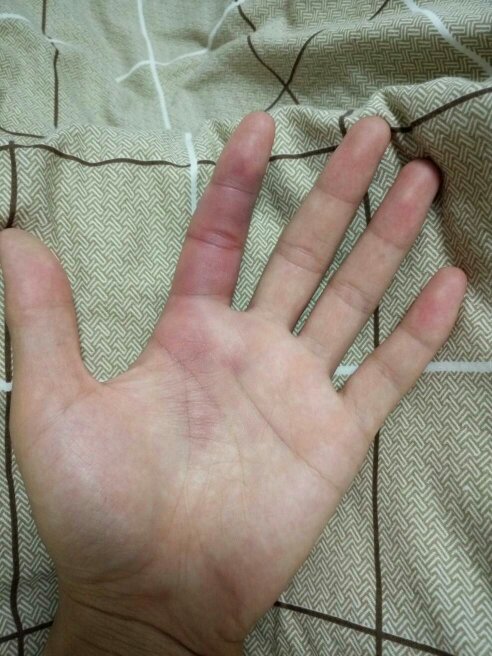 打篮球后手上长泡,打篮球脚上起水泡可以戳破吗