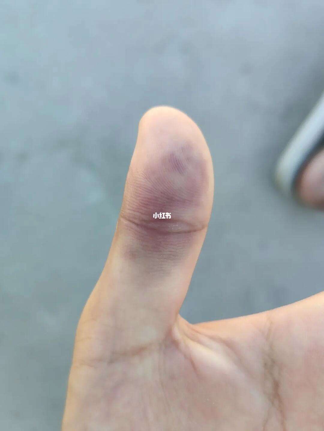 打篮球戳到拇指要几天,打篮球手指戳伤多久能自愈
